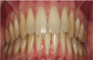 Solutions for Teeth Stains